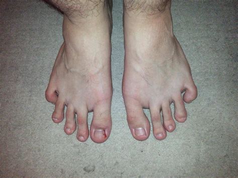 ugly feet pics